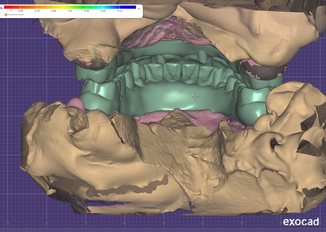 Рабочий процесс в 3Shape и exocad · 1/8