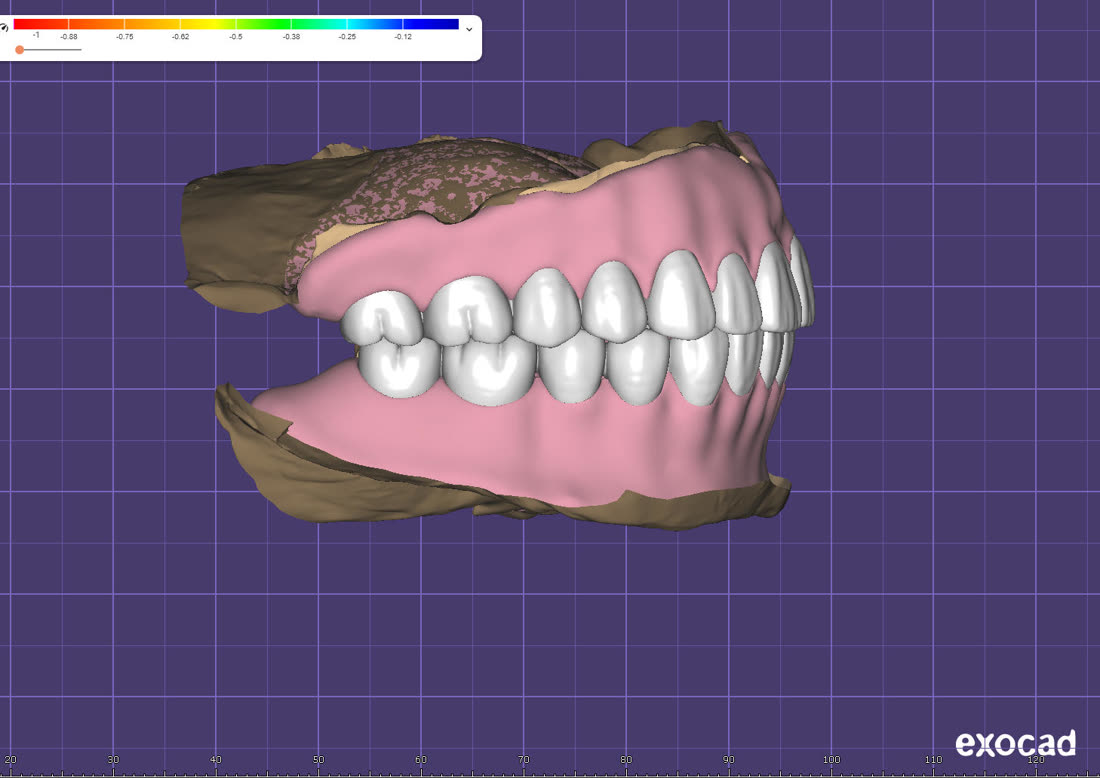 Рабочий процесс в 3Shape и exocad · 3/8