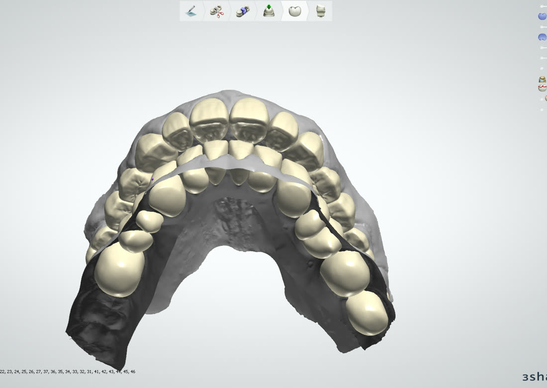 Рабочий процесс в 3Shape и exocad · 8/8